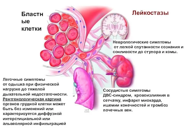 Легочные симптомы от одышка при физической нагрузке до тяжелой дыхательной недостаточности.