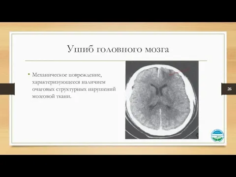 Ушиб головного мозга Механическое повреждение, характеризующееся наличием очаговых структурных нарушений мозговой ткани.