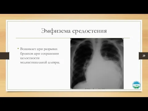 Эмфизема средостения Возникает при разрывах бронхов при сохранении целостности медиастинальной плевры.