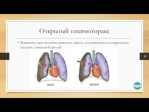 Открытый пневмоторакс Возникает при наличии раневого канала, соединяющего плевральную полость с внешней средой