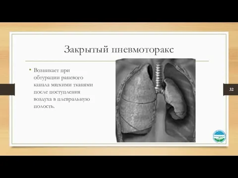 Закрытый пневмоторакс Возникает при обтурации раневого канала мягкими тканями после поступления воздуха в плевральную полость.