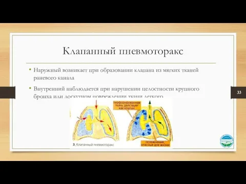 Клапанный пневмоторакс Наружный возникает при образовании клапана из мягких тканей раневого