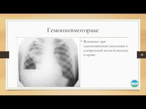 Гемопневмоторакс Возникает при одномоментном скоплении в плевральной полости воздуха и крови