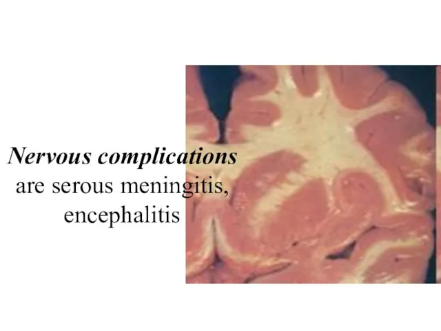 Nervous complications are serous meningitis, encephalitis