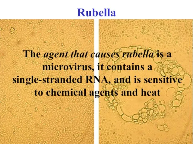 Rubella The agent that causes rubella is a microvirus, it contains