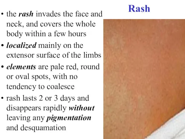 Rash the rash invades the face and neck, and covers the