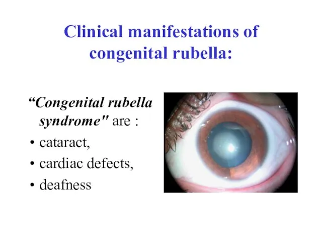 Clinical manifestations of congenital rubella: “Сongenital rubella syndrome" are : cataract, cardiac defects, deafness
