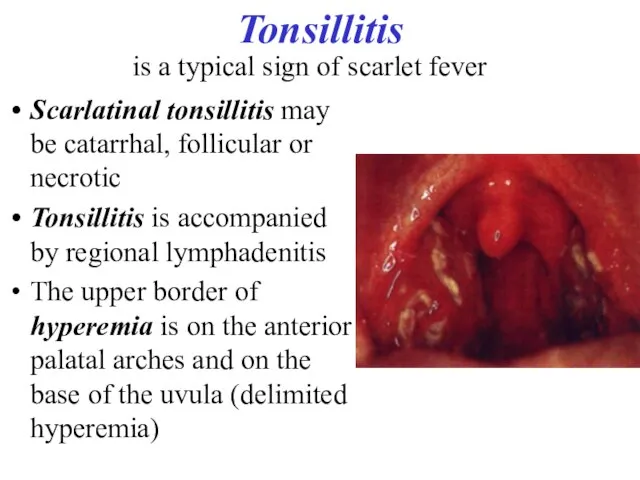 Tonsillitis Scarlatinal tonsillitis may be catarrhal, follicular or necrotic Tonsillitis is