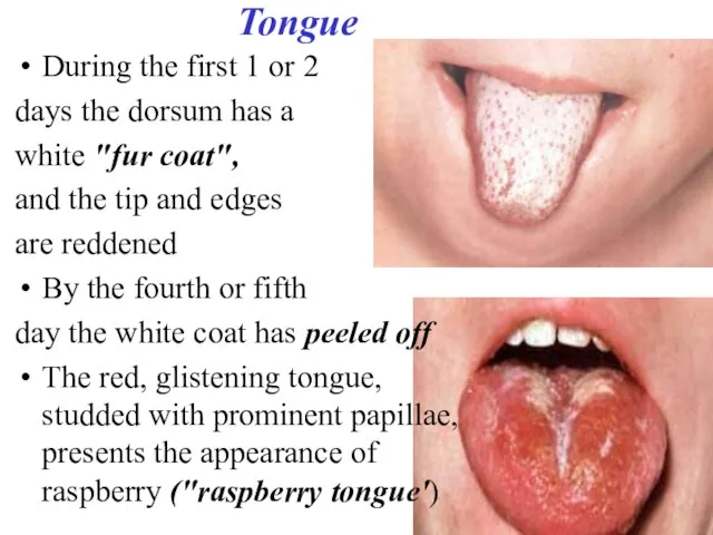 Tongue During the first 1 or 2 days the dorsum has