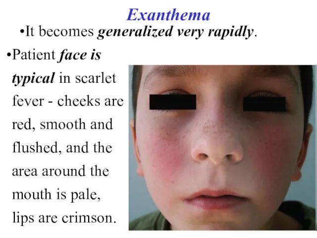 Exanthema It becomes generalized very rapidly. Patient face is typical in