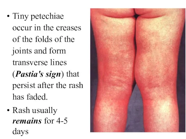 Tiny petechiae occur in the creases of the folds of the