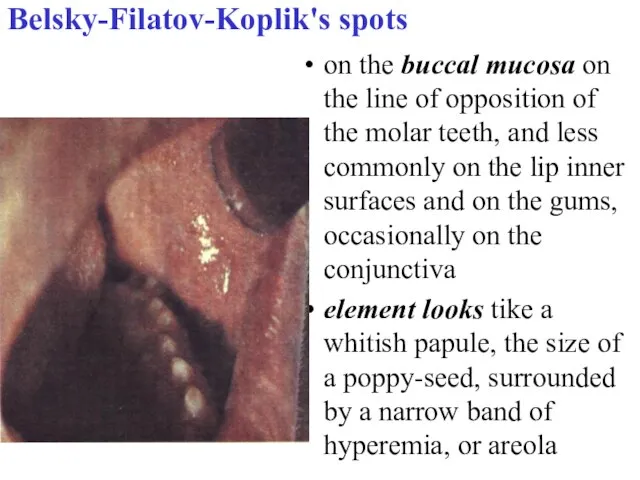 Belsky-Filatov-Koplik's spots on the buccal mucosa on the line of opposition