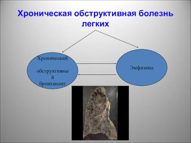 Хроническая обструктивная болезнь легких Хронический обструктивный бронхиолит Эмфизема