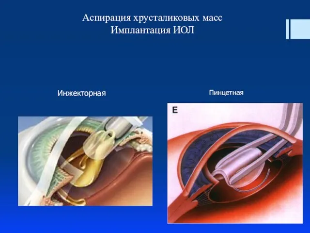 Аспирация хрусталиковых масс Имплантация ИОЛ Инжекторная Пинцетная