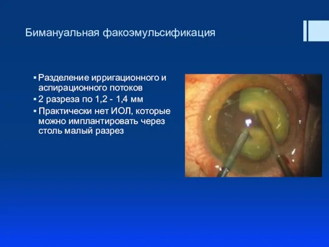 Бимануальная факоэмульсификация Разделение ирригационного и аспирационного потоков 2 разреза по 1,2