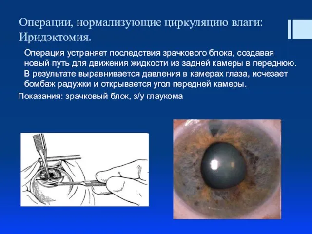 Операции, нормализующие циркуляцию влаги: Иридэктомия. Операция устраняет последствия зрачкового блока, создавая