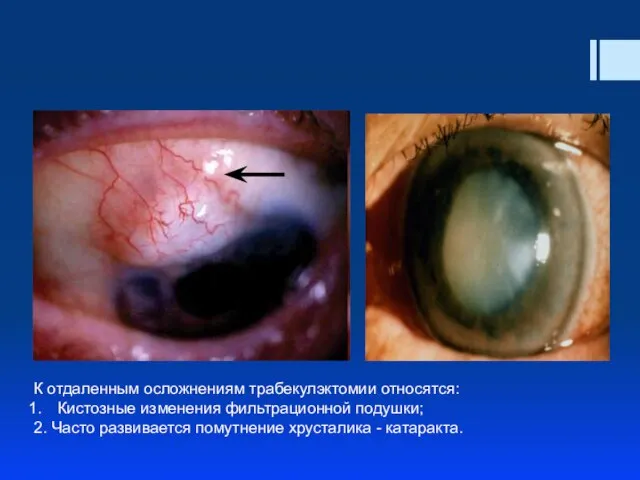 К отдаленным осложнениям трабекулэктомии относятся: Кистозные изменения фильтрационной подушки; 2. Часто развивается помутнение хрусталика - катаракта.