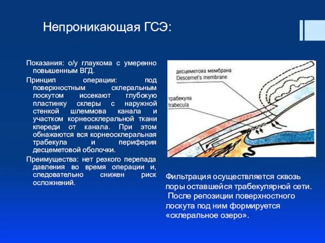 Непроникающая ГСЭ: Показания: о/у глаукома с умеренно повышенным ВГД. Принцип операции: