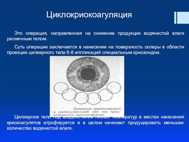 Это операция, направленная на снижение продукции водянистой влаги ресничным телом. Суть