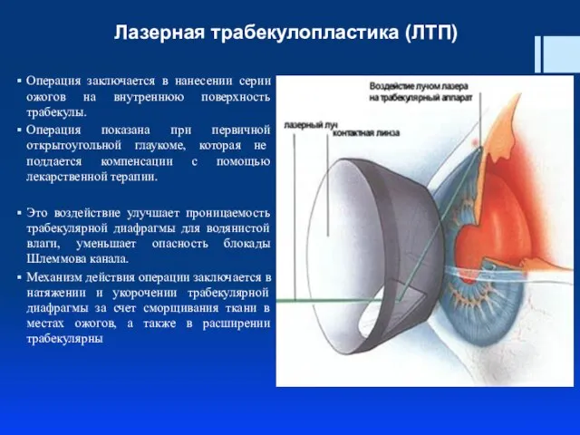 Лазерная трабекулопластика (ЛТП) Операция заключается в нанесении серии ожогов на внутреннюю