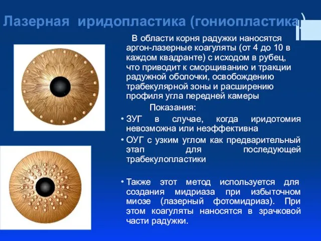 Лазерная иридопластика (гониопластика) В области корня радужки наносятся аргон-лазерные коагуляты (от