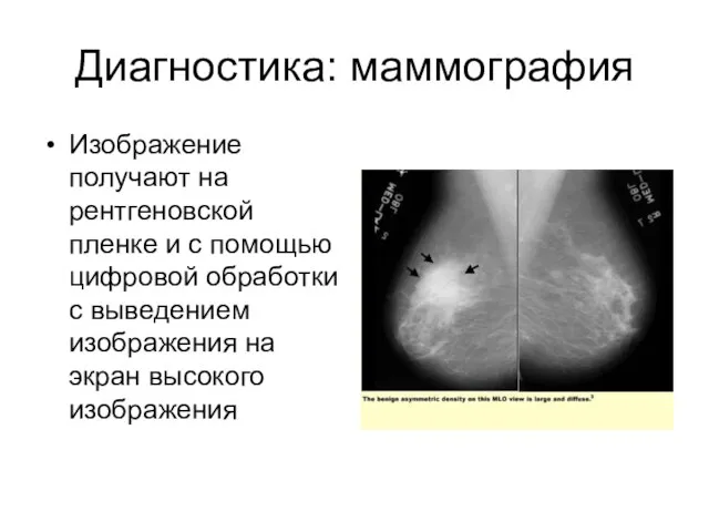 Диагностика: маммография Изображение получают на рентгеновской пленке и с помощью цифровой