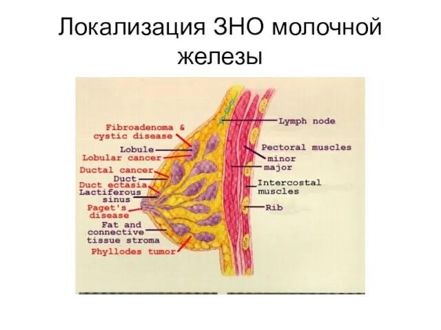 Локализация ЗНО молочной железы