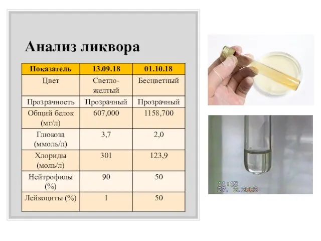 Анализ ликвора