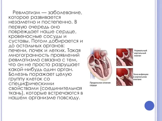 Ревматизм — заболевание, которое развивается незаметно и постепенно. В первую очередь