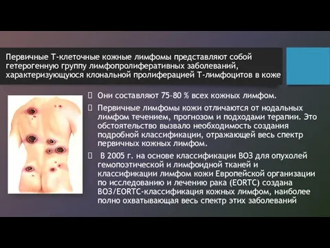 Первичные Т-клеточные кожные лимфомы представляют собой гетерогенную группу лимфопролиферативных заболеваний, характеризующуюся