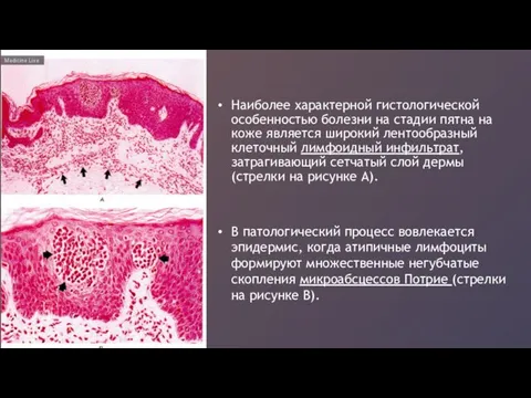 Наиболее характерной гистологической особенностью болезни на стадии пятна на коже является