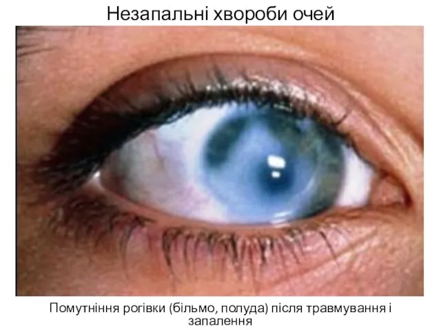 Незапальні хвороби очей Помутніння рогівки (більмо, полуда) після травмування і запалення