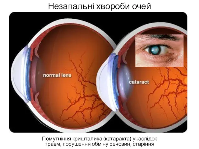 Незапальні хвороби очей Помутніння кришталика (катаракта) унаслідок травм, порушення обміну речовин, старіння