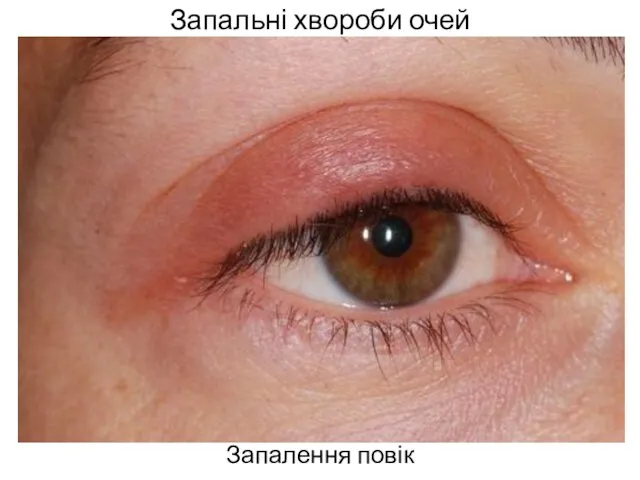Запальні хвороби очей Запалення повік
