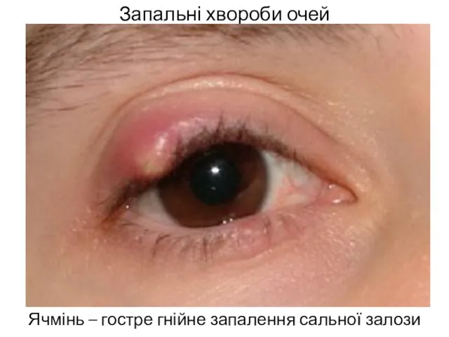 Запальні хвороби очей Ячмінь – гостре гнійне запалення сальної залози