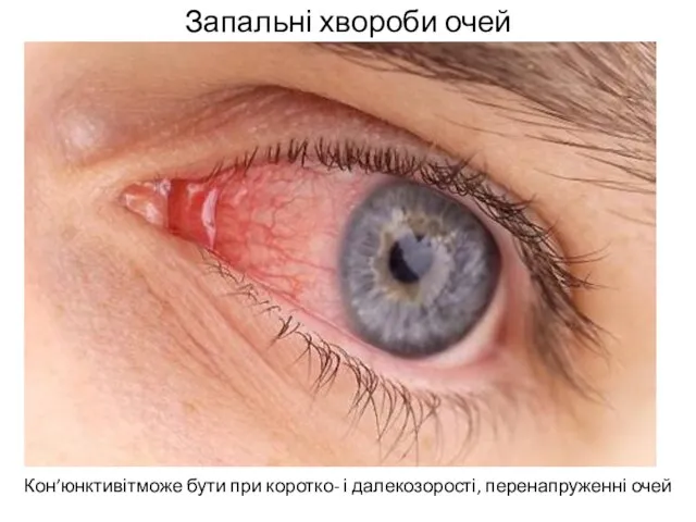 Запальні хвороби очей Кон’юнктивітможе бути при коротко- і далекозорості, перенапруженні очей