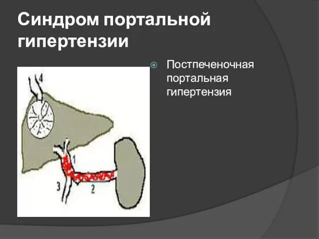 Синдром портальной гипертензии Постпеченочная портальная гипертензия