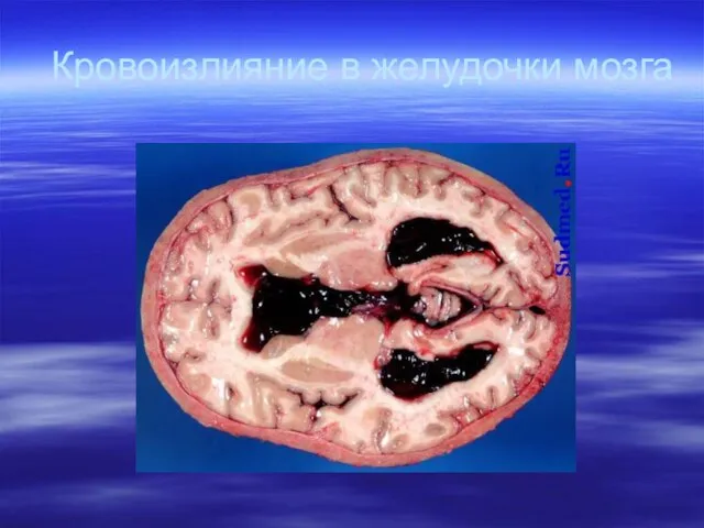 Кровоизлияние в желудочки мозга