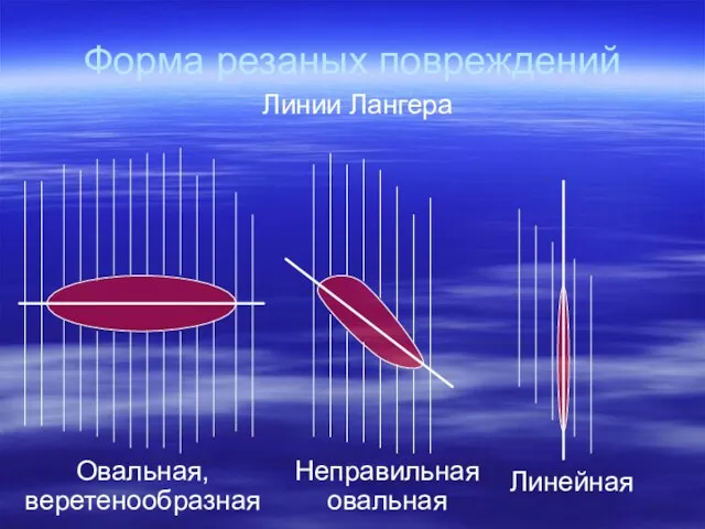 Форма резаных повреждений Линии Лангера Овальная, веретенообразная Неправильная овальная Линейная