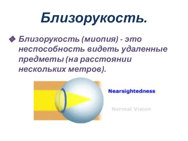 Близорукость. Близорукость (миопия) - это неспособность видеть удаленные предметы (на расстоянии нескольких метров).