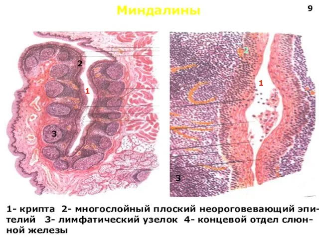 Миндалины 1 1 2 2 3 3 1- крипта 2- многослойный