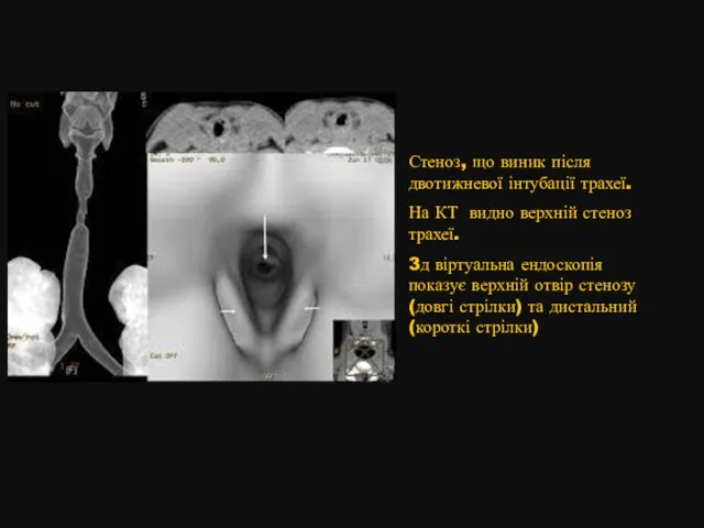 Стеноз, що виник після двотижневої інтубації трахеї. На КТ видно верхній