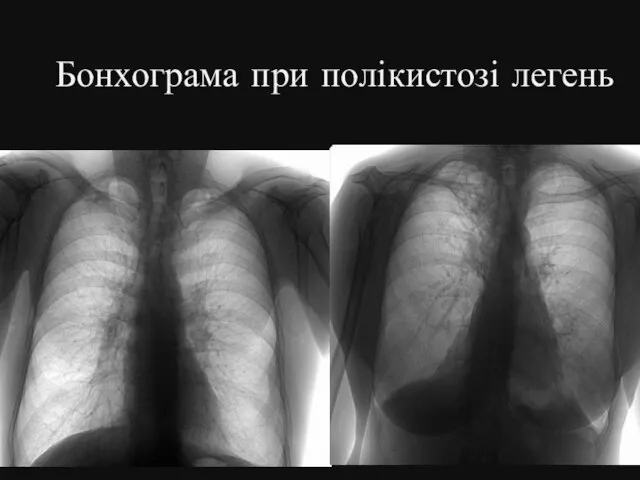 Бонхограма при полікистозі легень