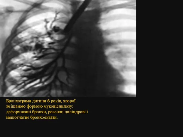 Бронхограма дитини 6 років, хворої змішаною формою муковісцидозу: деформовані бронхи, розсіяні циліндрові і мешотчатиє бронхоектази.