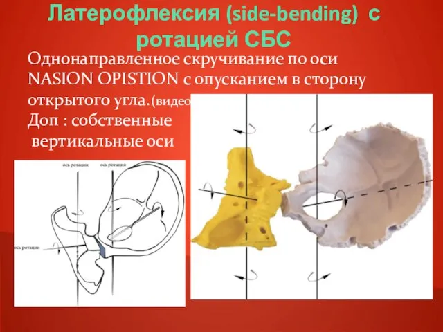 Латерофлексия (side-bending) с ротацией СБС Однонаправленное скручивание по оси NASION OPISTION