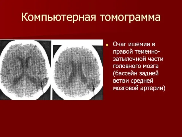 Компьютерная томограмма Очаг ишемии в правой теменно-затылочной части головного мозга (бассейн задней ветви средней мозговой артерии)