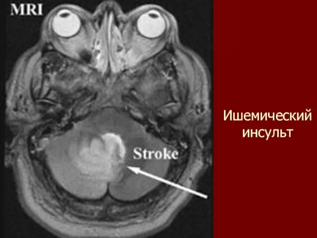 Ишемический инсульт