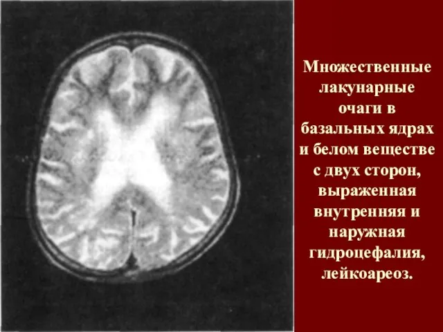 Множественные лакунарные очаги в базальных ядрах и белом веществе с двух