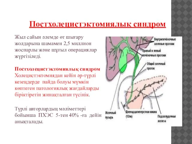 Постхолецистэктомиялық синдром Жыл сайын әлемде өт шығару жолдарына шамамен 2,5 миллион