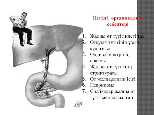 Жалпы өт түтігіндегі тас Өтқуық түтігінің ұзын культиясы Одди сфинктрінің спазмы